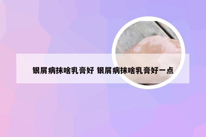 银屑病抹啥乳膏好 银屑病抹啥乳膏好一点