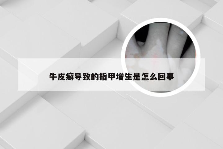 牛皮癣导致的指甲增生是怎么回事
