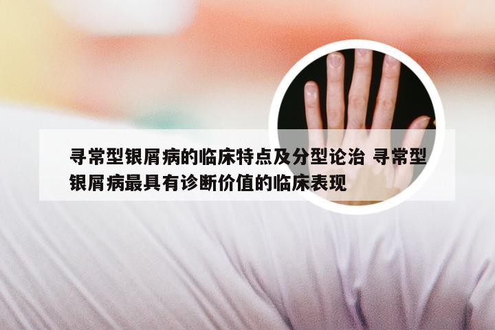 寻常型银屑病的临床特点及分型论治 寻常型银屑病最具有诊断价值的临床表现
