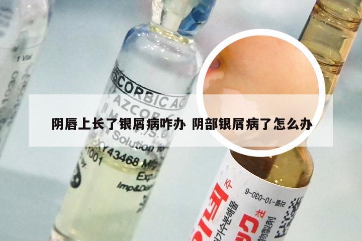 阴唇上长了银屑病咋办 阴部银屑病了怎么办