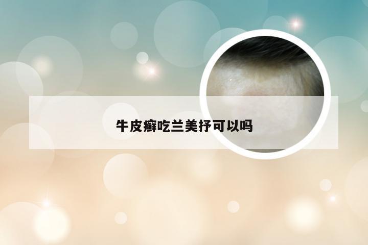 牛皮癣吃兰美抒可以吗