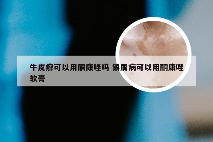 牛皮癣可以用酮康唑吗 银屑病可以用酮康唑软膏