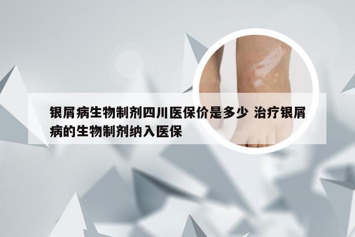 银屑病生物制剂四川医保价是多少 治疗银屑病的生物制剂纳入医保