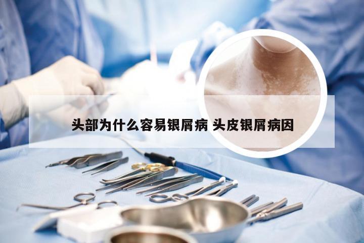 头部为什么容易银屑病 头皮银屑病因
