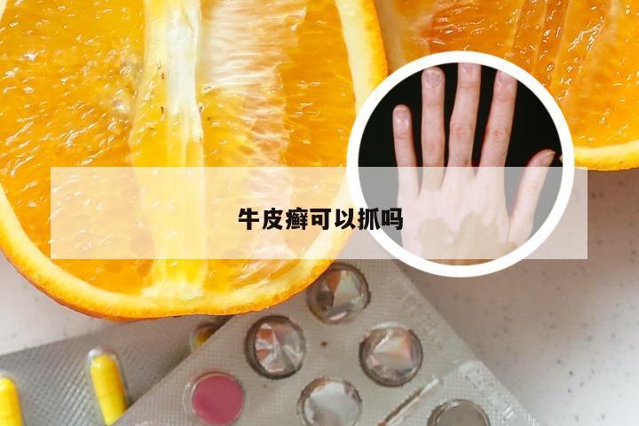 牛皮癣可以抓吗