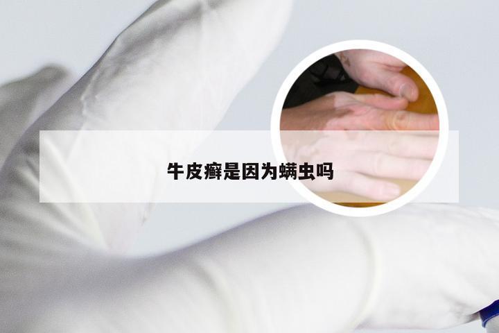 牛皮癣是因为螨虫吗