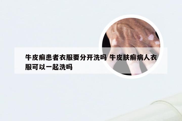 牛皮癣患者衣服要分开洗吗 牛皮肤癣病人衣服可以一起洗吗