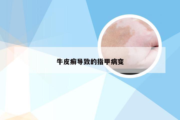 牛皮癣导致的指甲病变