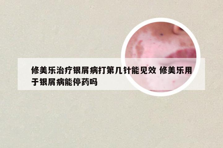 修美乐治疗银屑病打第几针能见效 修美乐用于银屑病能停药吗