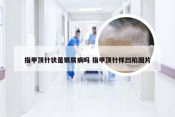 指甲顶针状是银屑病吗 指甲顶针样凹陷图片