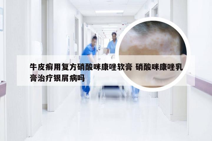 牛皮癣用复方硝酸咪康唑软膏 硝酸咪康唑乳膏治疗银屑病吗