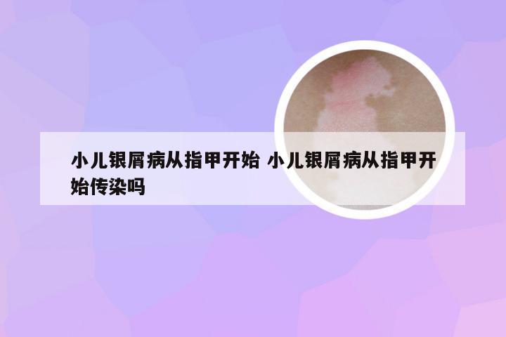 小儿银屑病从指甲开始 小儿银屑病从指甲开始传染吗