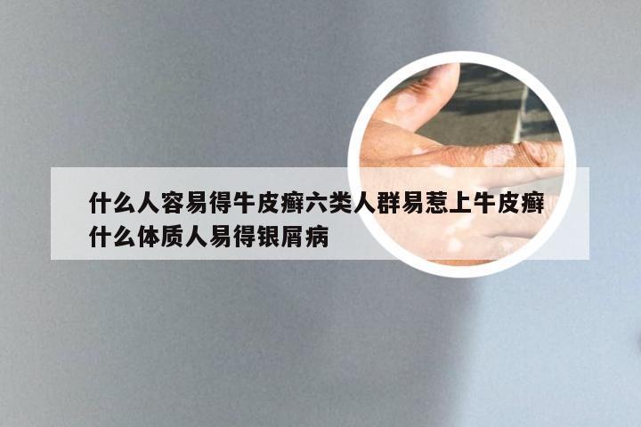 什么人容易得牛皮癣六类人群易惹上牛皮癣 什么体质人易得银屑病