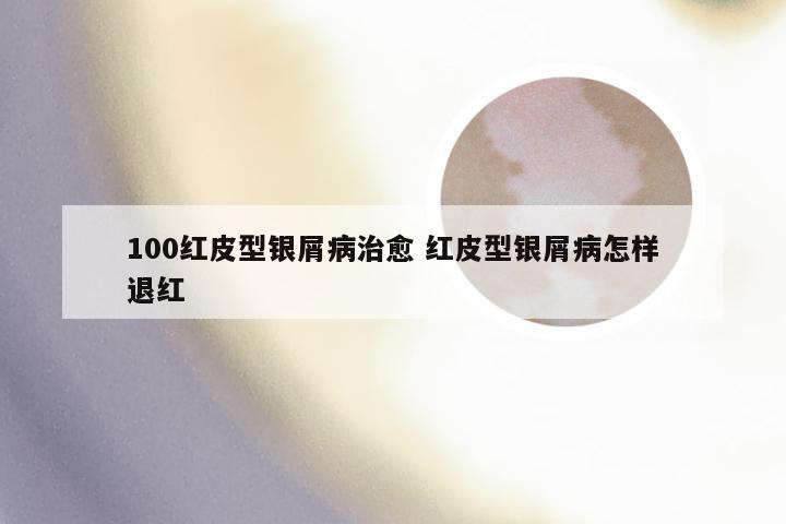 100红皮型银屑病治愈 红皮型银屑病怎样退红