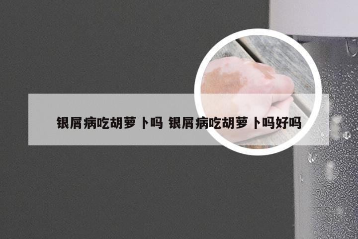 银屑病吃胡萝卜吗 银屑病吃胡萝卜吗好吗