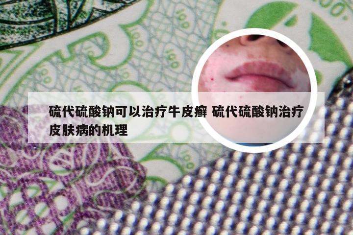 硫代硫酸钠可以治疗牛皮癣 硫代硫酸钠治疗皮肤病的机理