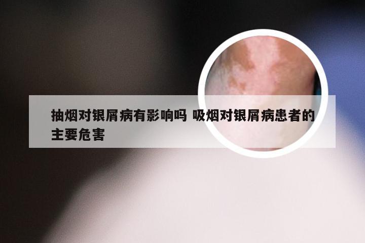 抽烟对银屑病有影响吗 吸烟对银屑病患者的主要危害