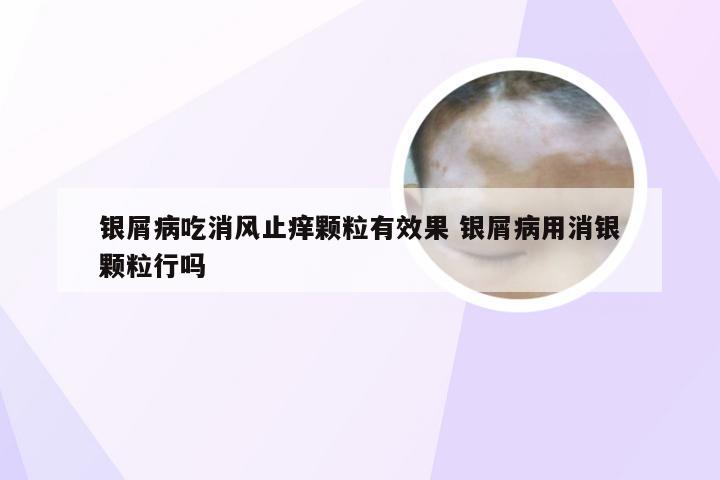 银屑病吃消风止痒颗粒有效果 银屑病用消银颗粒行吗