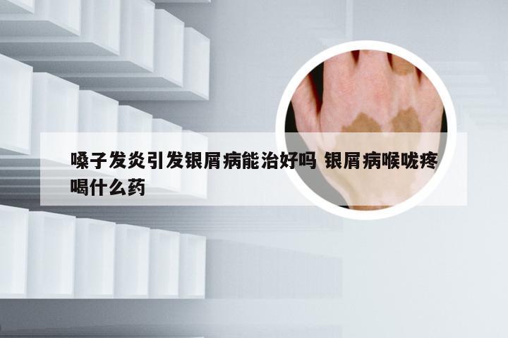 嗓子发炎引发银屑病能治好吗 银屑病喉咙疼喝什么药