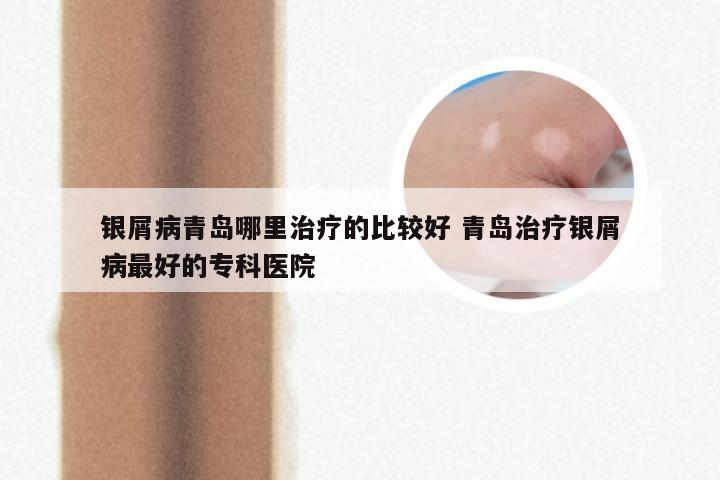 银屑病青岛哪里治疗的比较好 青岛治疗银屑病最好的专科医院