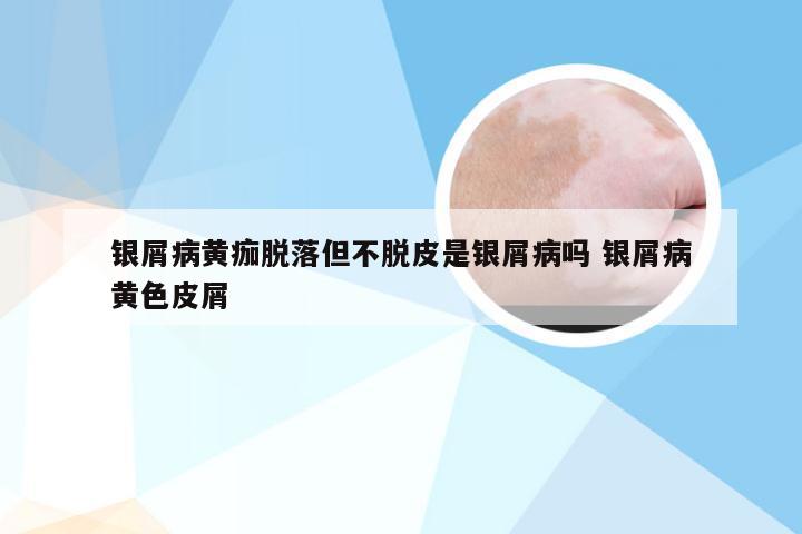 银屑病黄痂脱落但不脱皮是银屑病吗 银屑病黄色皮屑