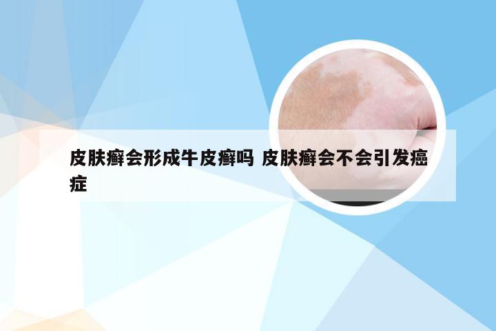 皮肤癣会形成牛皮癣吗 皮肤癣会不会引发癌症