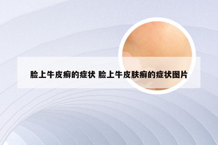 脸上牛皮癣的症状 脸上牛皮肤癣的症状图片