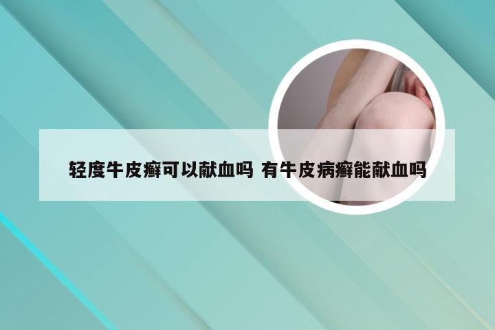 轻度牛皮癣可以献血吗 有牛皮病癣能献血吗