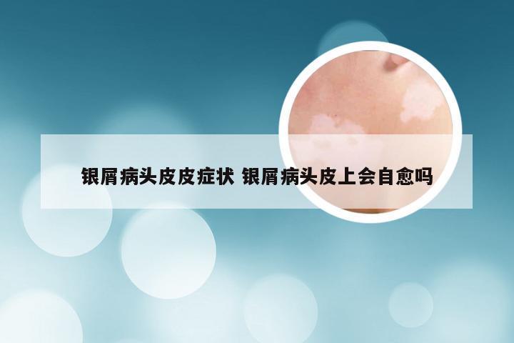 银屑病头皮皮症状 银屑病头皮上会自愈吗