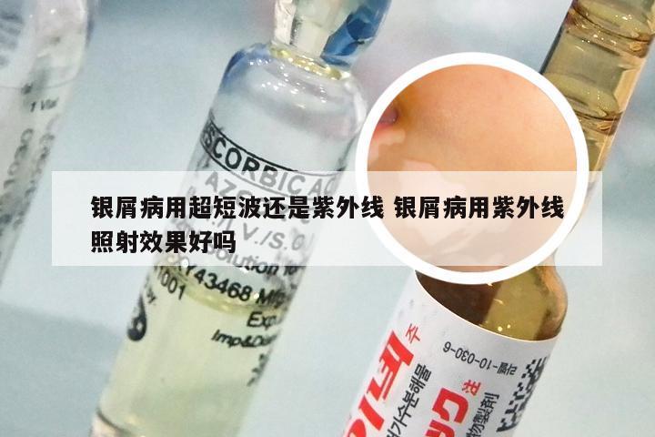 银屑病用超短波还是紫外线 银屑病用紫外线照射效果好吗