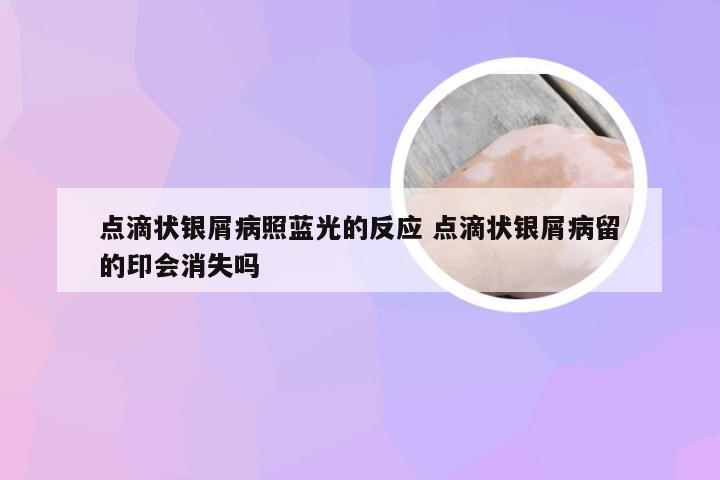 点滴状银屑病照蓝光的反应 点滴状银屑病留的印会消失吗