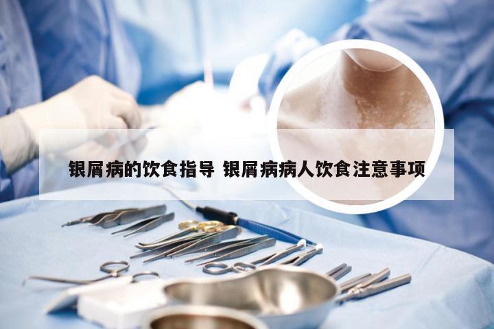 银屑病的饮食指导 银屑病病人饮食注意事项