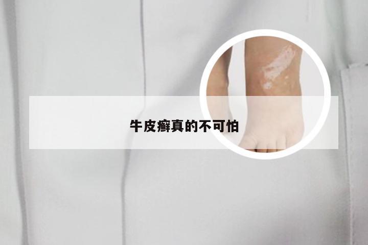 牛皮癣真的不可怕