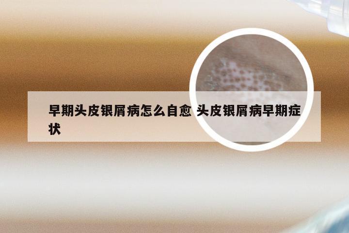 早期头皮银屑病怎么自愈 头皮银屑病早期症状