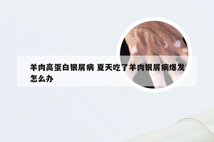 羊肉高蛋白银屑病 夏天吃了羊肉银屑病爆发怎么办