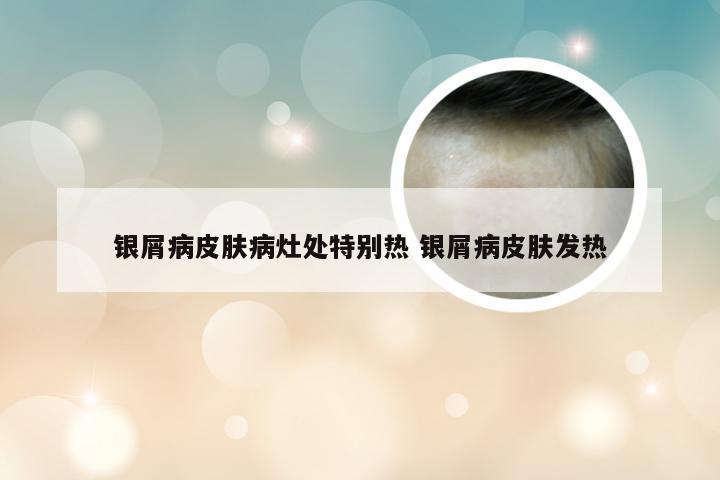 银屑病皮肤病灶处特别热 银屑病皮肤发热