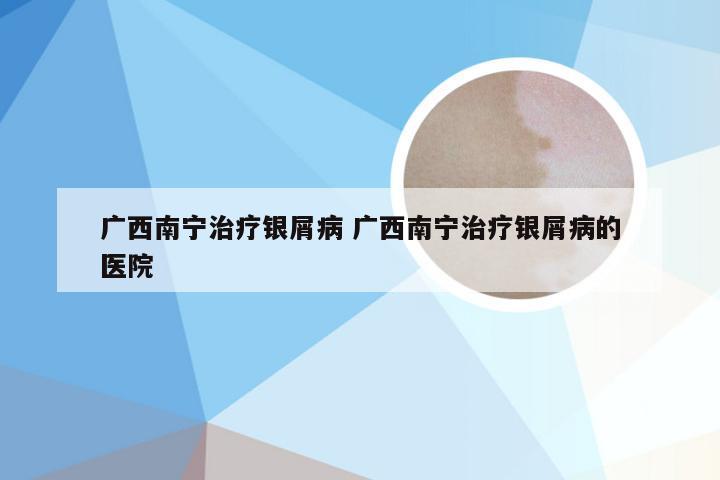 广西南宁治疗银屑病 广西南宁治疗银屑病的医院