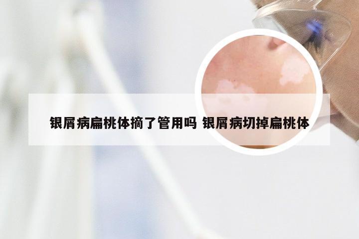 银屑病扁桃体摘了管用吗 银屑病切掉扁桃体