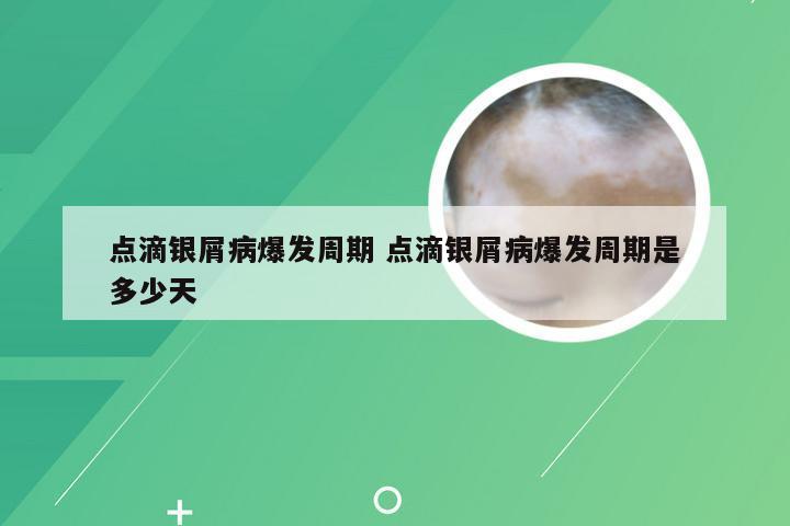 点滴银屑病爆发周期 点滴银屑病爆发周期是多少天