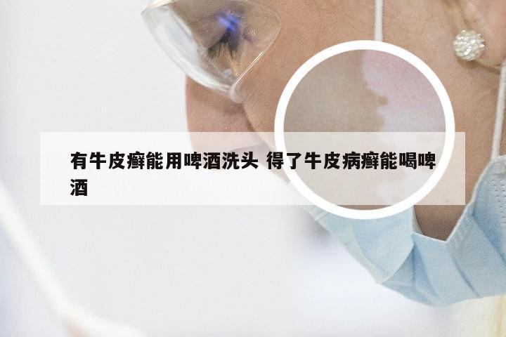 有牛皮癣能用啤酒洗头 得了牛皮病癣能喝啤酒