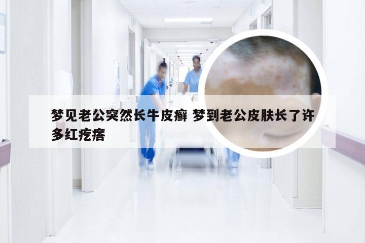 梦见老公突然长牛皮癣 梦到老公皮肤长了许多红疙瘩