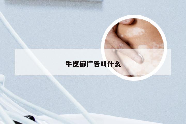牛皮癣广告叫什么