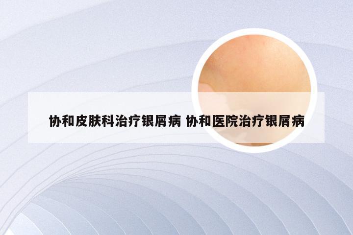 协和皮肤科治疗银屑病 协和医院治疗银屑病
