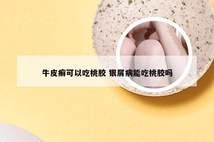 牛皮癣可以吃桃胶 银屑病能吃桃胶吗