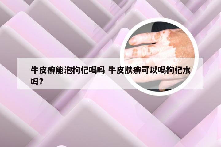 牛皮癣能泡枸杞喝吗 牛皮肤癣可以喝枸杞水吗?