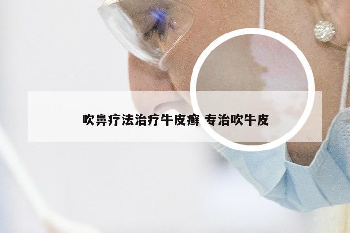 吹鼻疗法治疗牛皮癣 专治吹牛皮