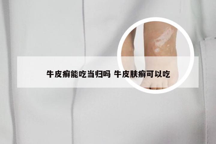 牛皮癣能吃当归吗 牛皮肤癣可以吃