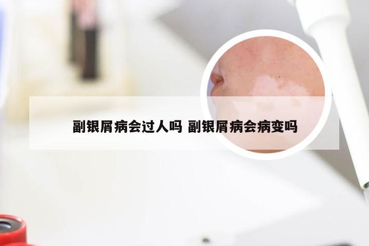 副银屑病会过人吗 副银屑病会病变吗
