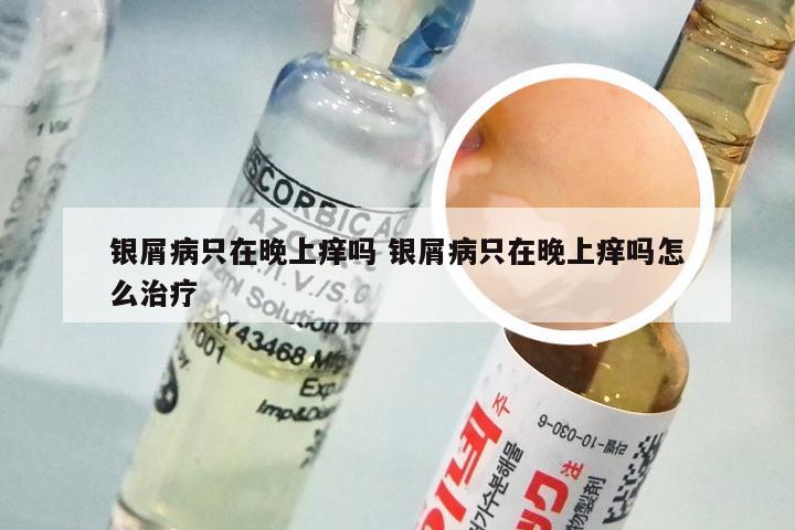 银屑病只在晚上痒吗 银屑病只在晚上痒吗怎么治疗