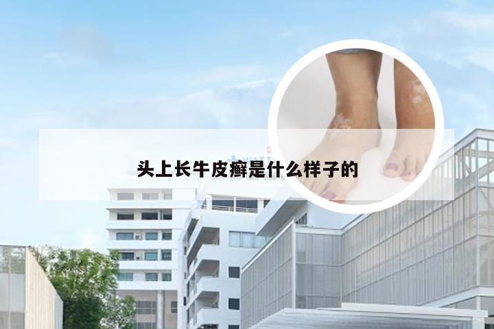 头上长牛皮癣是什么样子的